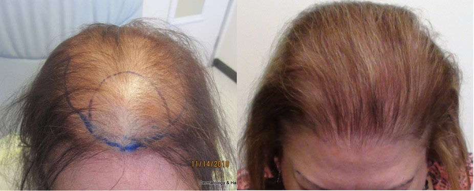 Womens hair restoration LA before and after
