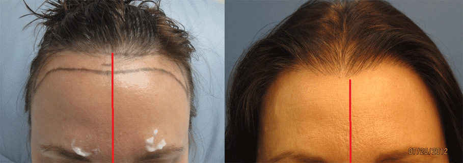 Womens hair transplant Los Angeles