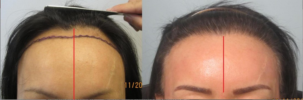 Women's hair transplant before and after