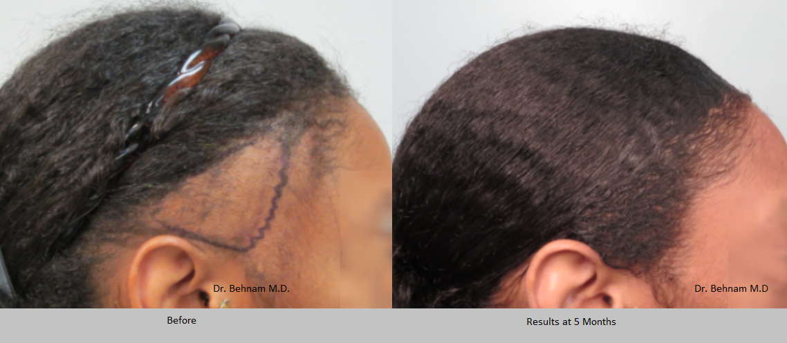 Female African American hair restoration