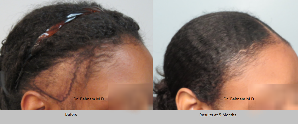 African American women hair transplant Los Angeles