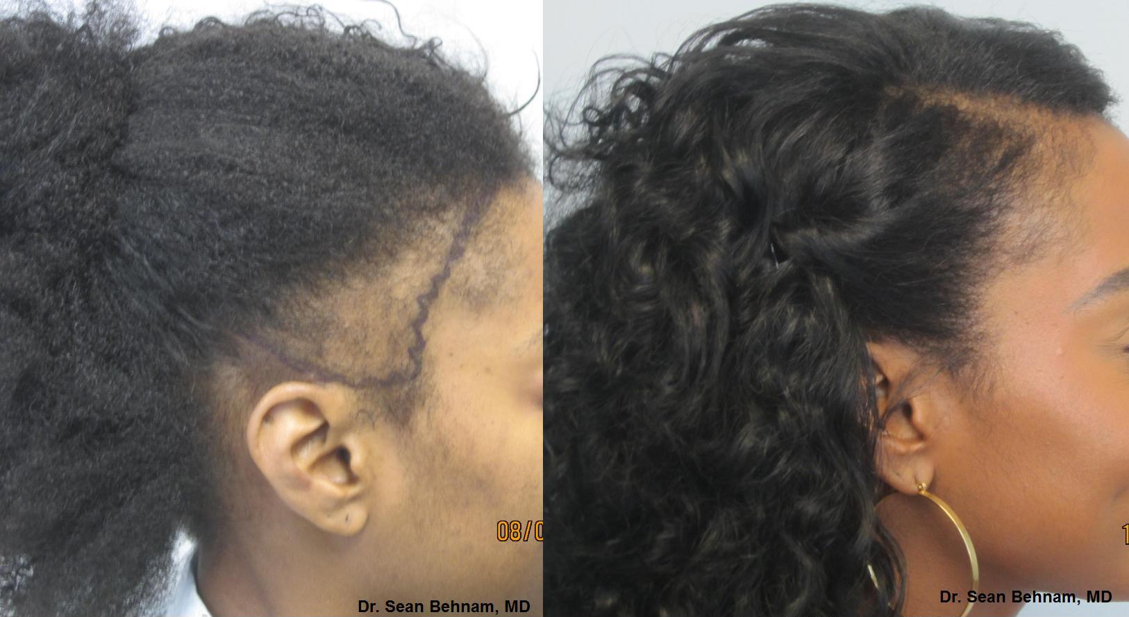 Woman or female before and after hair transplant