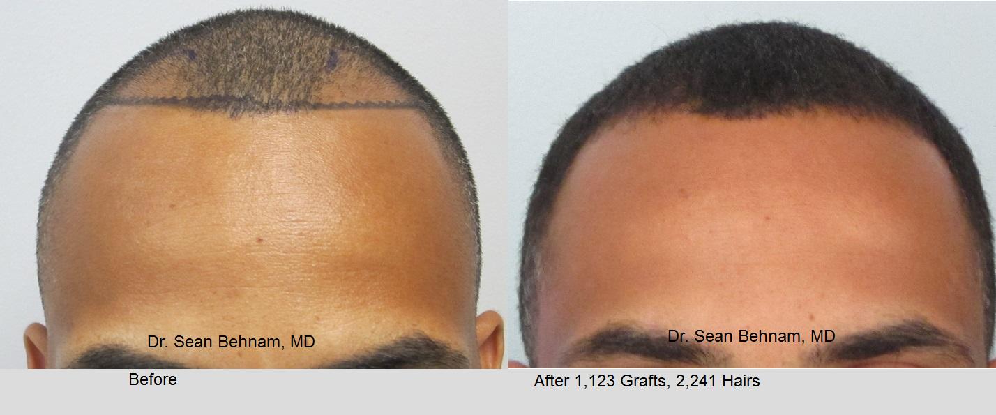 Men S African American Hair Transplant Dr Sean Behnam