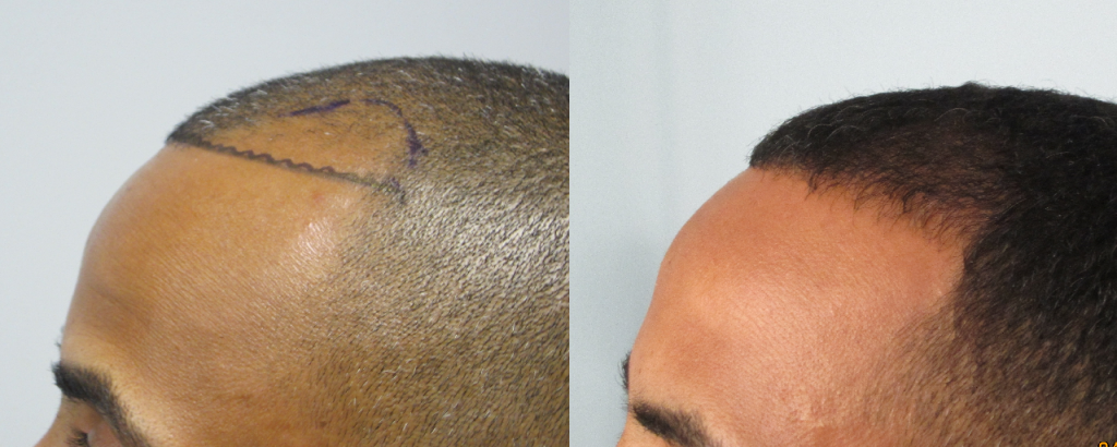 FUE hair transplant African American: (side view) Patient received 1,123 grafts (2,241 hairs) along the hairline and temples. Results after 1 year.