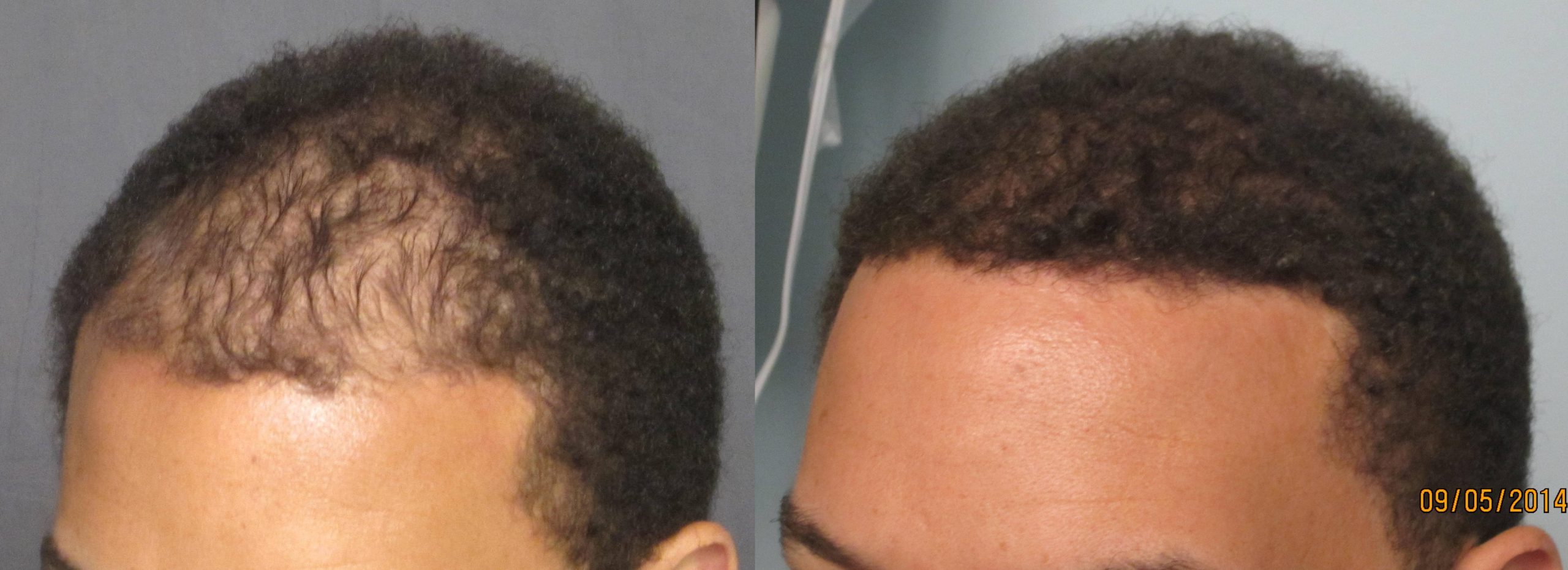 Men's African American Hair Transplant - Dr. Sean Behnam