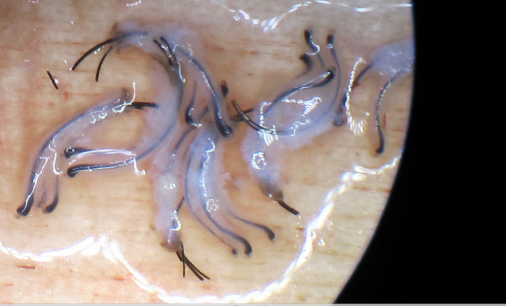 African American Hair follicle obtained by the FUE method. Please notice how curly the grafts are. Also, please notice thatthe grafts are not transected. They are fully intact 2 hair and 3 hair follicles. Great tissue around them. FUE performed by Dr Behnam MD ABHRS