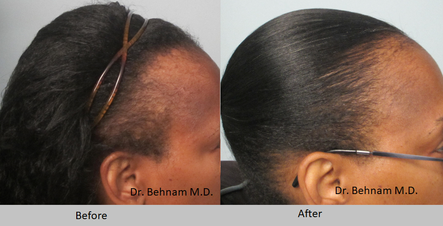 African American Female hair transplant. Grafts are placed along the hairline and temples.