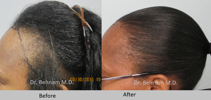 African American Female hair transplant. Grafts are placed along the hairline and temples.