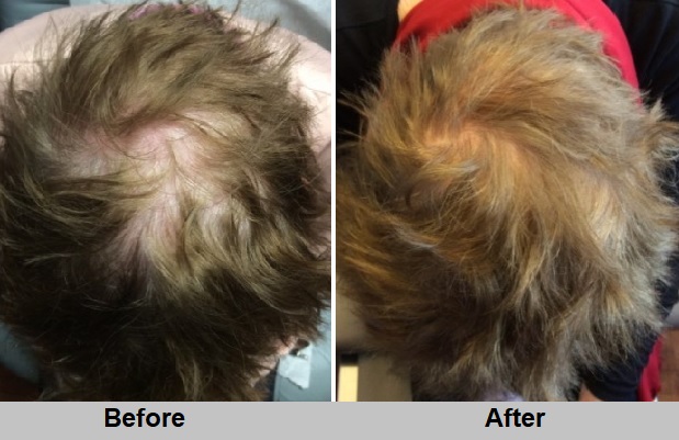 Topical finasteride before and after by Dr. Behnam