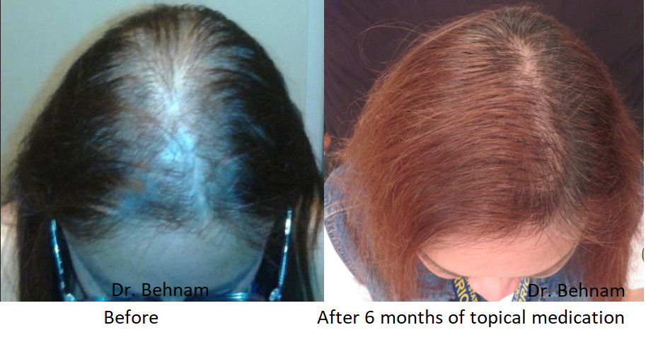 Topical Finasteride for Hair Growth - Men and Women Hair Loss