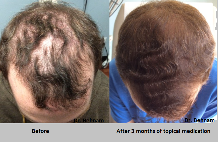 Topical finasteride before and after