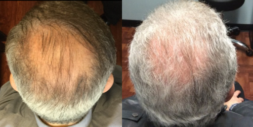 Male patient before and after topical finasteride solution