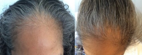 Topical finasteride before and after on woman head and forehead