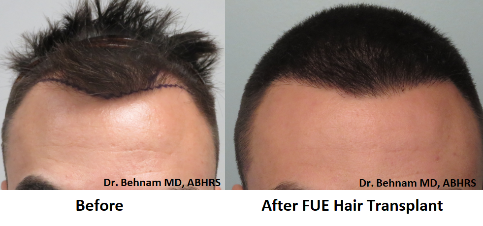 FUE Hair Transplant Los Angeles - Dr. Sean Behnam