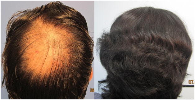 Los Angeles hair loss back of head