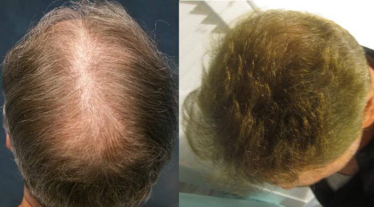 Hair transplant LA