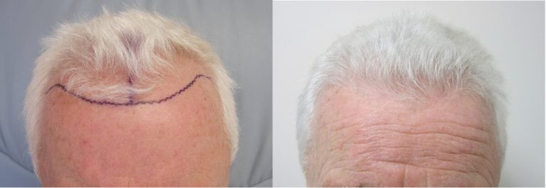 Hair transplant before and after picture