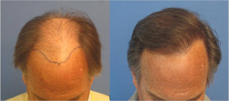 Hair Transplant Los Angeles Cost - Cost of Hair Restoration in Los Angeles