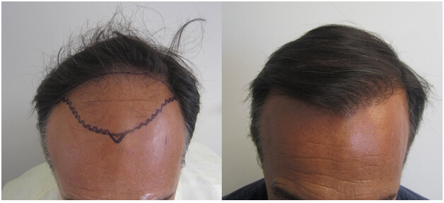 Hair Transplant Los Angeles Cost - Cost of Hair Restoration in Los Angeles