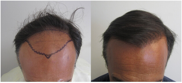 Average cost deals of hair transplant