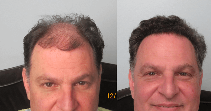 FUE hair transplant before and after in Los Angeles