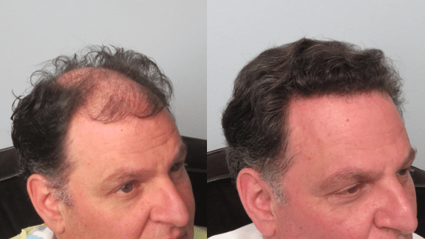 FUE hair transplant before and after in Los Angeles