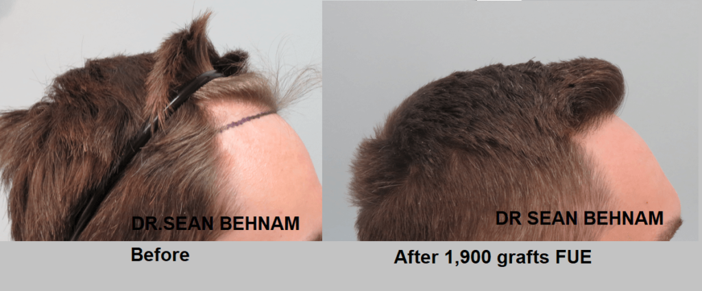 FUE procedure method - hair transplant Los Angeles before and after