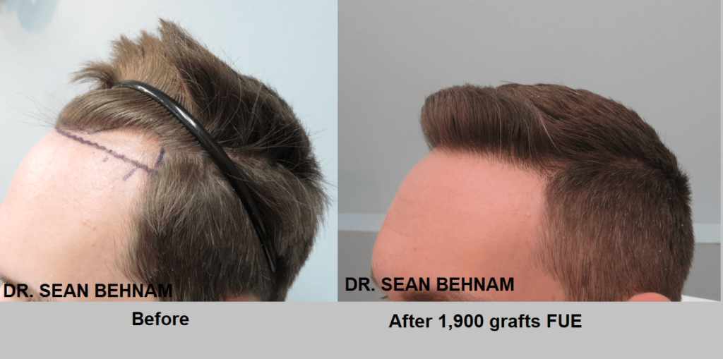 FUE procedure method - hair transplant Los Angeles before and after