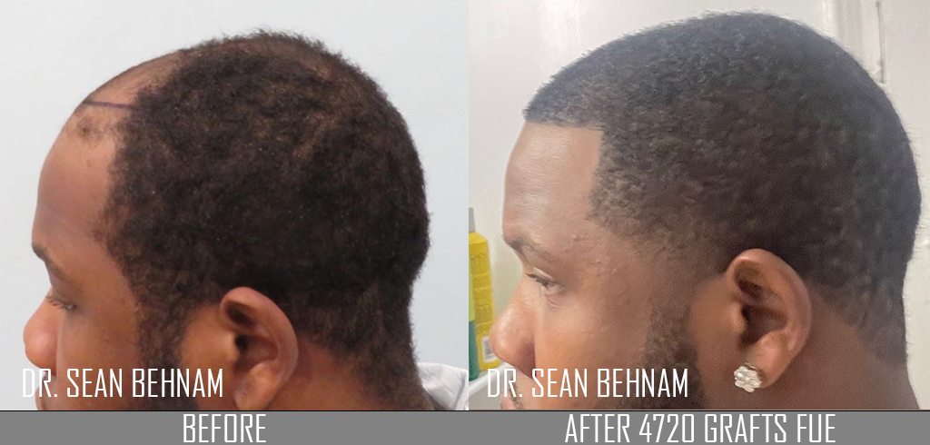 Men's African American Hair Transplant - Dr. Sean Behnam