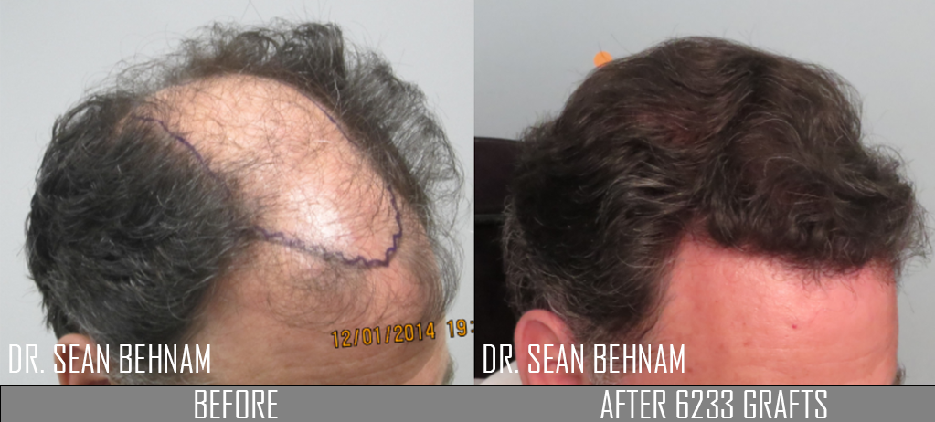 3,000 graft hair restoration result - AlviArmani - Hair Transplant Los  Angeles