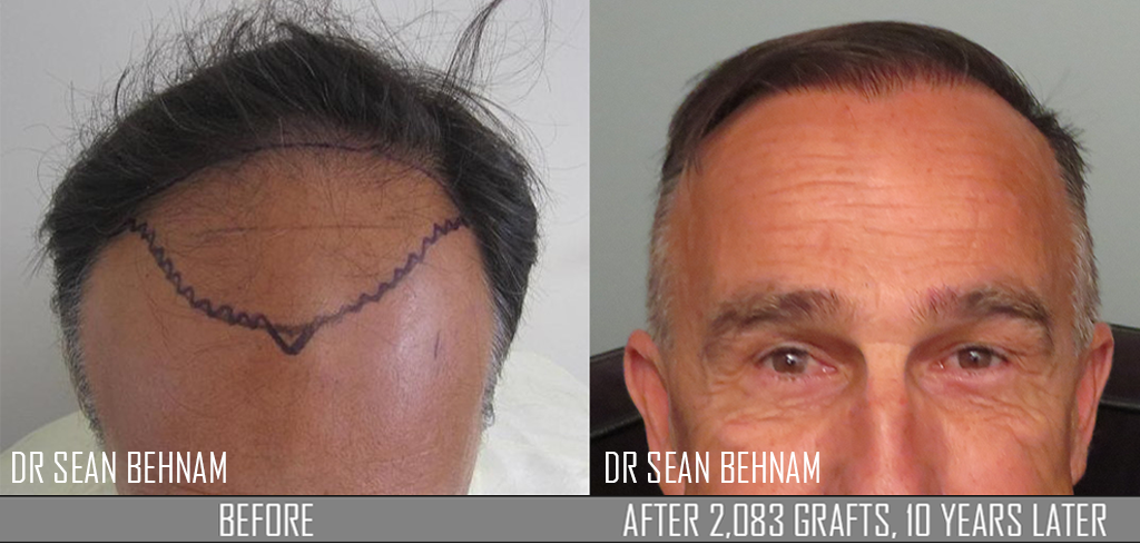 Importance of conservative hair line design for long-term naturalness and  age-appropriateness - Hair Restoration Los Angeles - Dr. Sean Behnam MD
